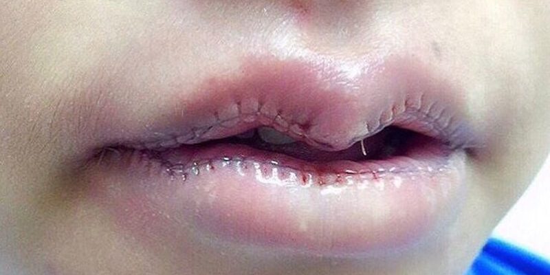 Новый азийский тренд красоты у женщин подрезание верхней губы